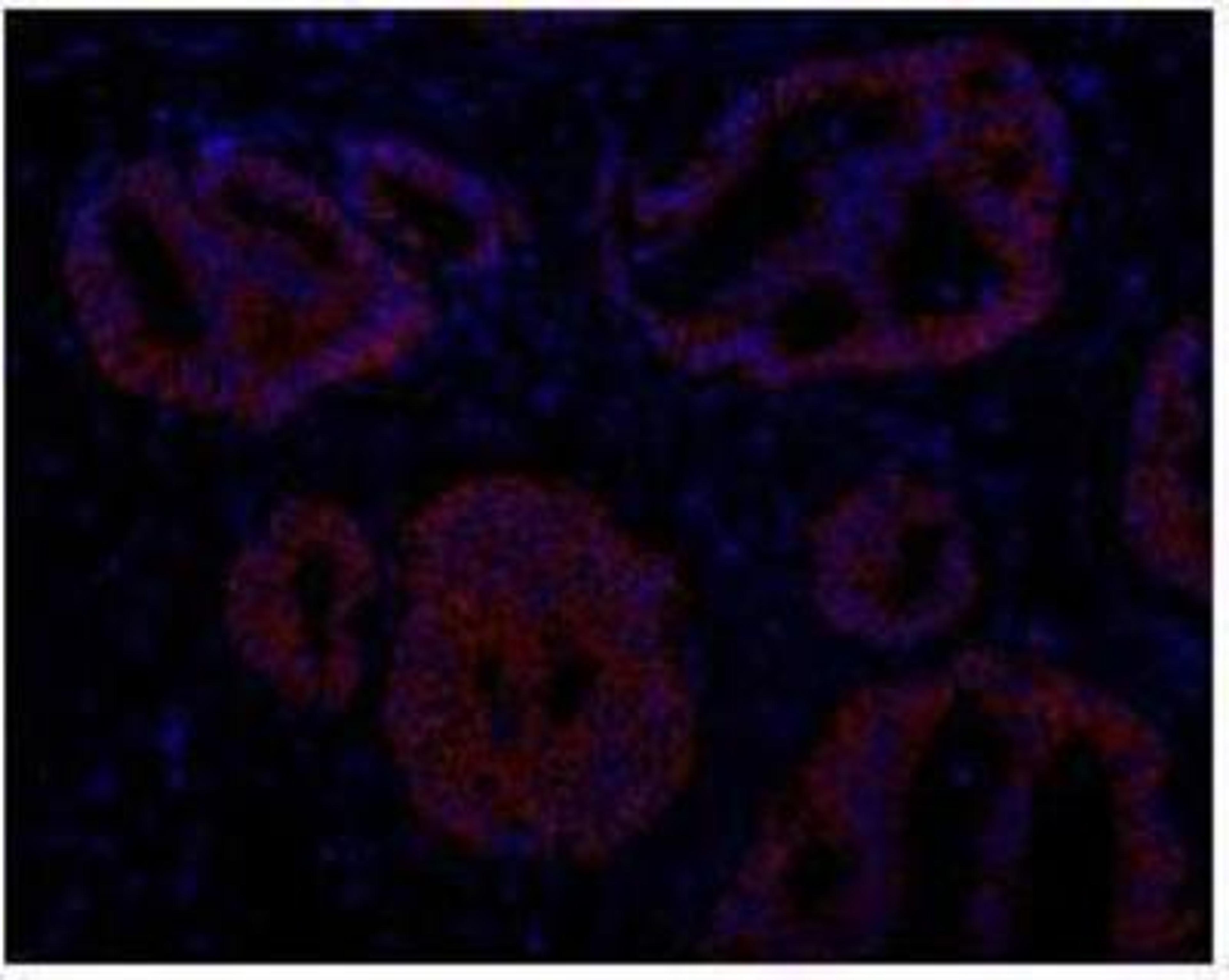 Immunocytochemistry/Immunofluorescence: ABCB9 Antibody [NBP1-18886] - FFPE section of human prostate carcinoma. Antibody:  Affinity purified rabbit anti-ABCB9 used  at a dilution of 1:100. Detection: Red-fluorescent goat anti-rabbit IgG highly cross-adsorbed Antibody Hilyte PlusTM 555 used at a dilution of 1:100.