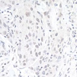 Detection of human ZEB1 by immunohistochemistry.