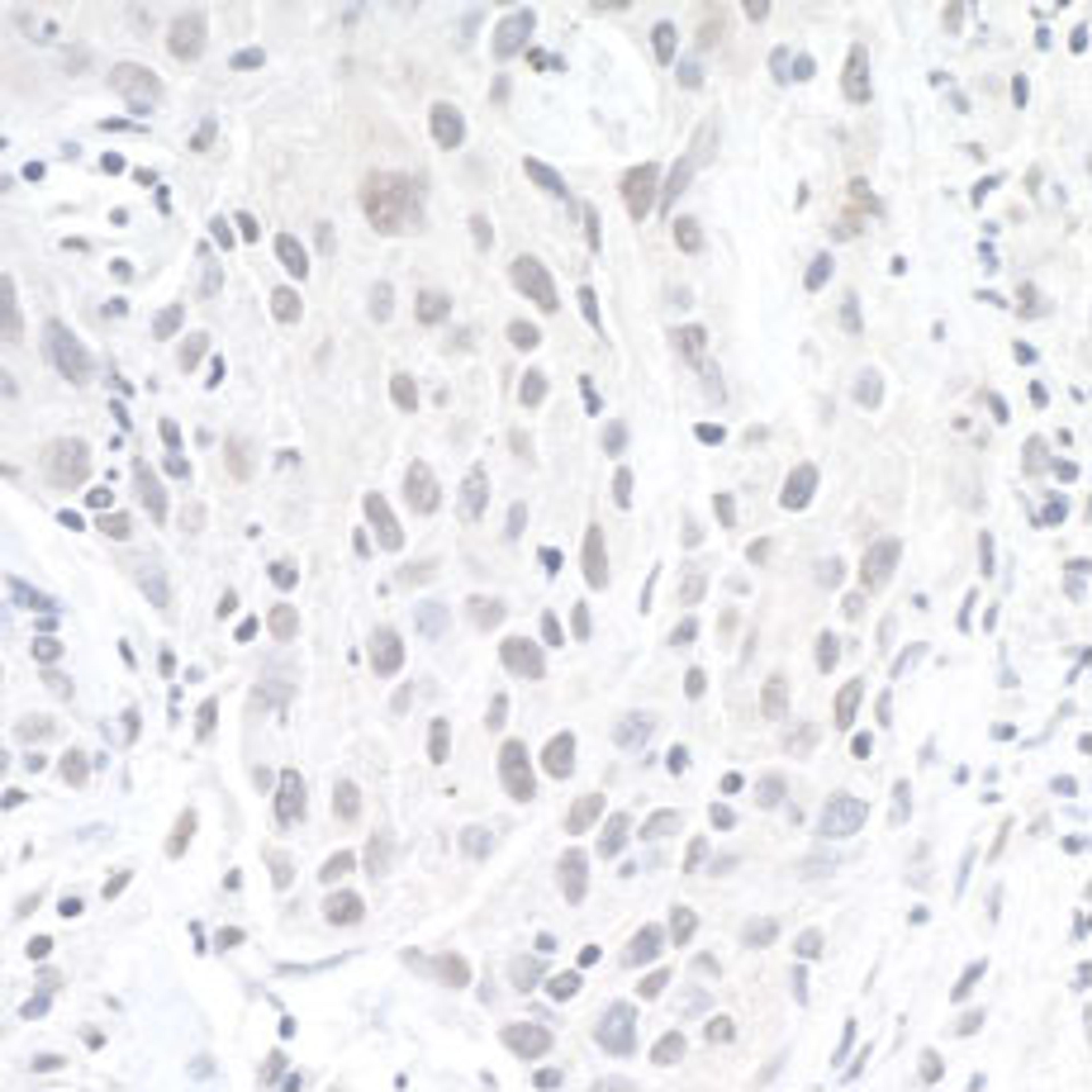 Detection of human ZEB1 by immunohistochemistry.