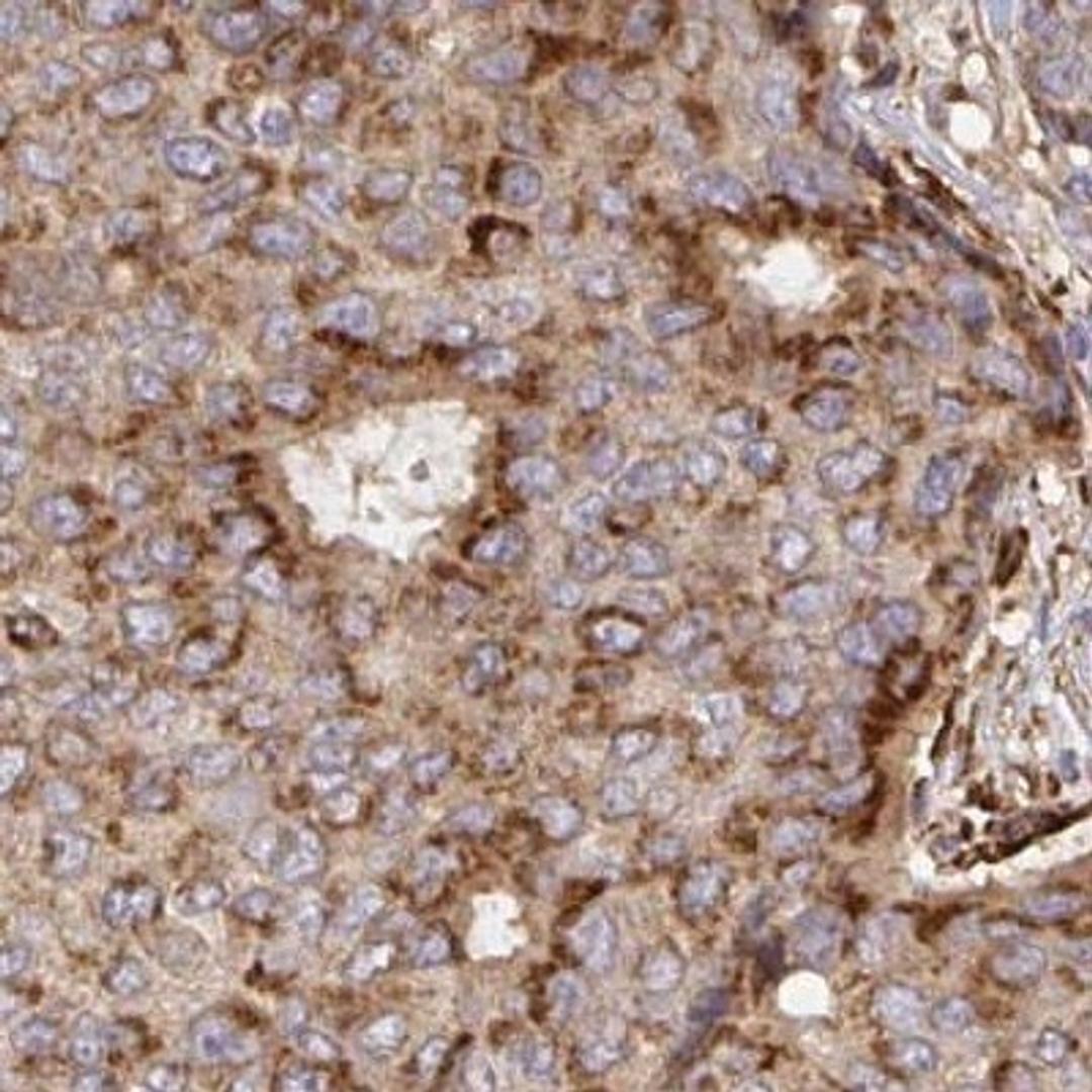 Immunohistochemistry: TM9SF4 Antibody [NBP2-32382] - breast cancer