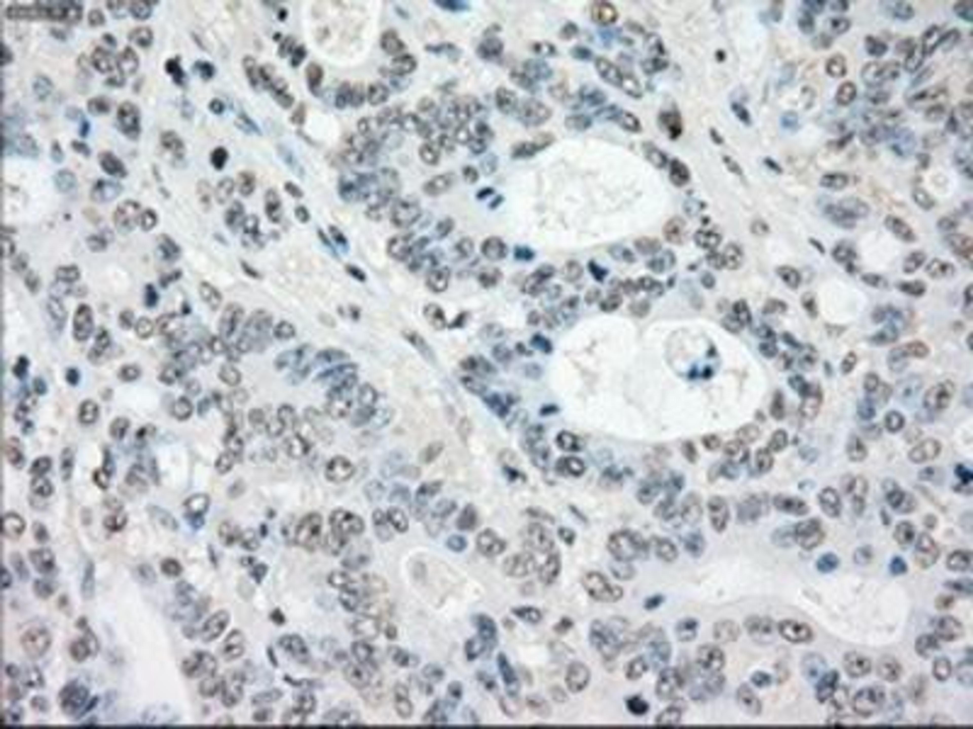 Immunohistochemistry-Paraffin: MST2/STK3 Antibody (4G10) [NBP1-48017] - Staining of paraffin-embedded Adenocarcinoma of colon tissue using anti-MST2 mouse monoclonal antibody.