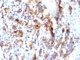 Formalin-fixed, paraffin-embedded human gastric carcinoma stained with Mucin-5AC antibody (SPM297).