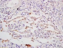 Immunohistochemical staining of human lung carcinoma tissue using C6orf150 antibody.