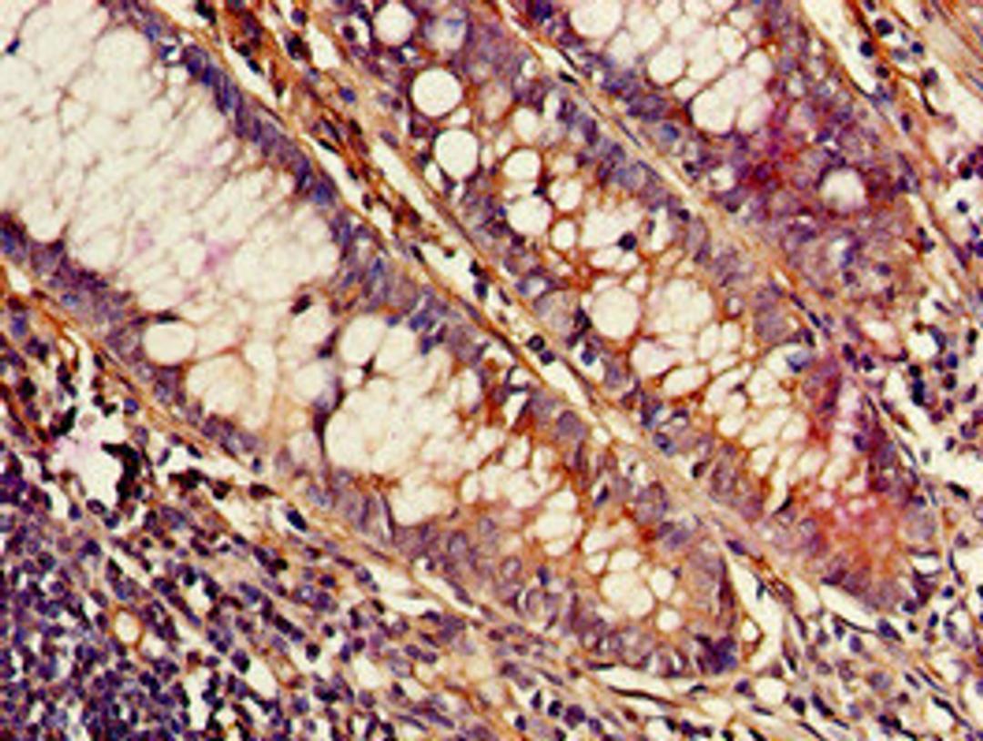 Immunohistochemistry of paraffin-embedded human colon cancer using CSB-PA891548LA01HU at dilution of 1:100