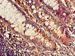 Immunohistochemistry of paraffin-embedded human colon cancer using CSB-PA891548LA01HU at dilution of 1:100