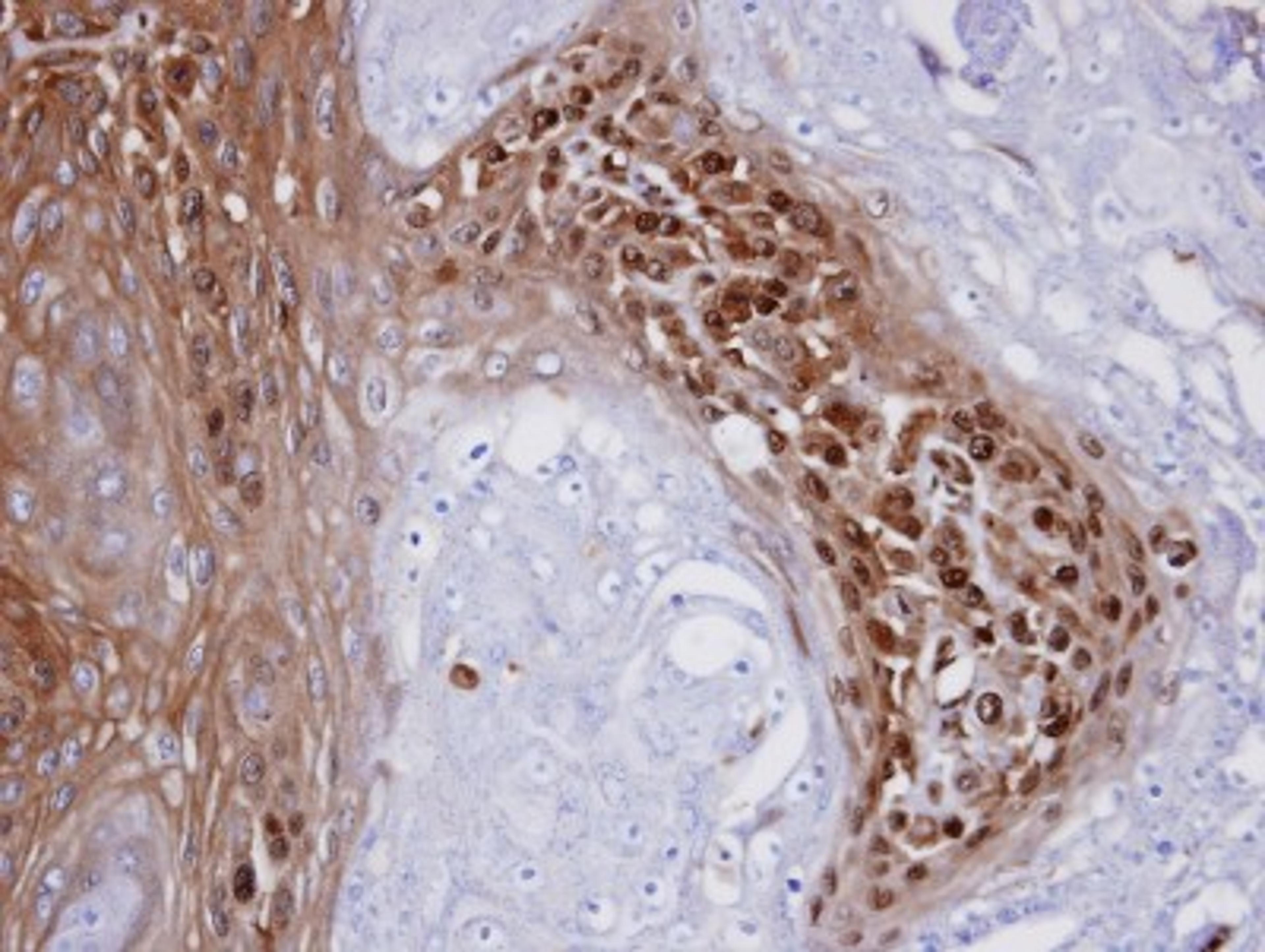 Immunohistochemistry-Paraffin: WBSCR22 Antibody [NBP1-31454] - Paraffin-embedded CA922 xenograft, using antibody at 1:100 dilution.