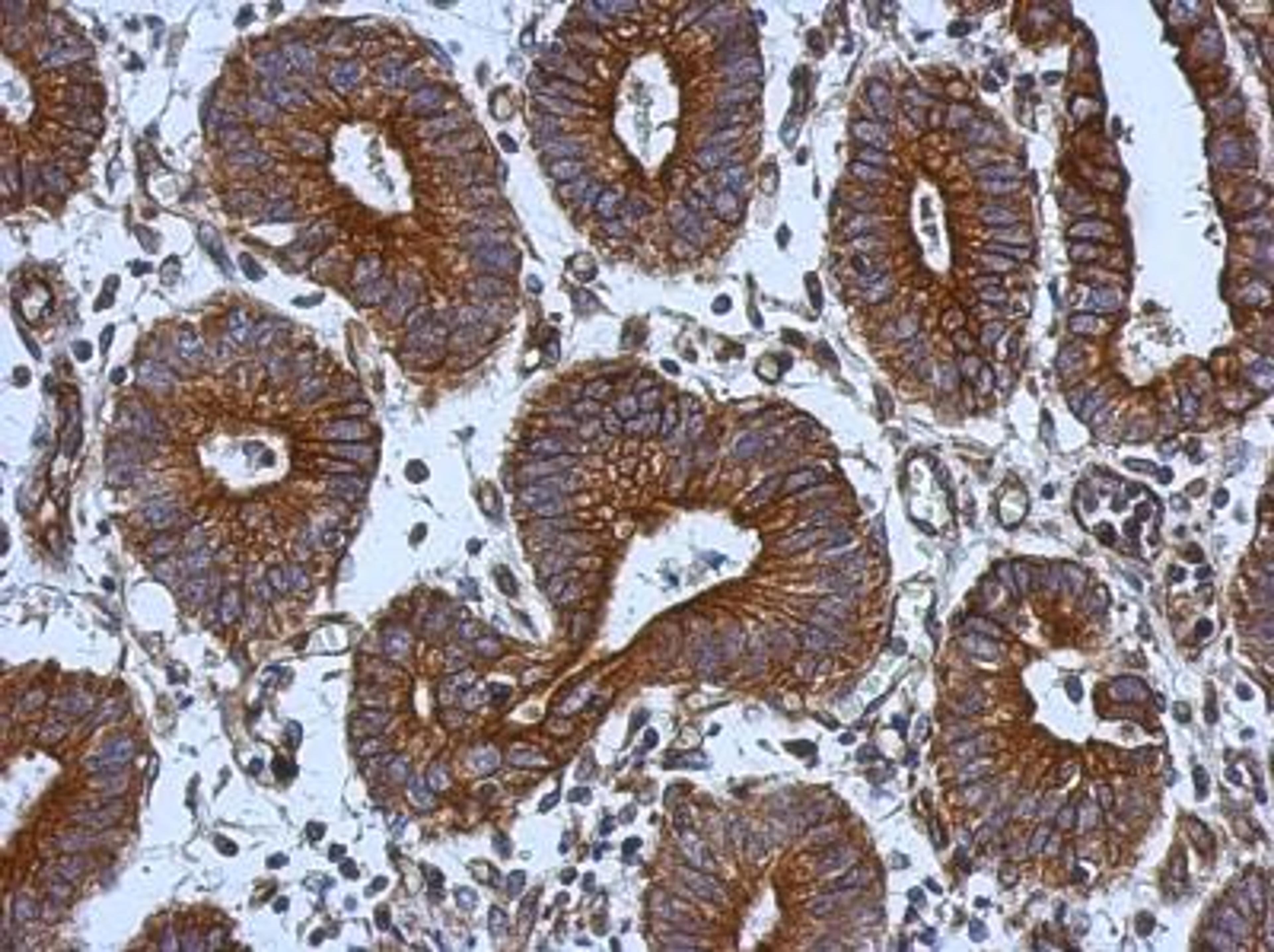 Immunohistochemistry-Paraffin: Tie-1 Antibody [NBP2-20635] -  Immunohistochemical analysis of paraffin-embedded Colon ca, using antibody at 1:500 dilution.