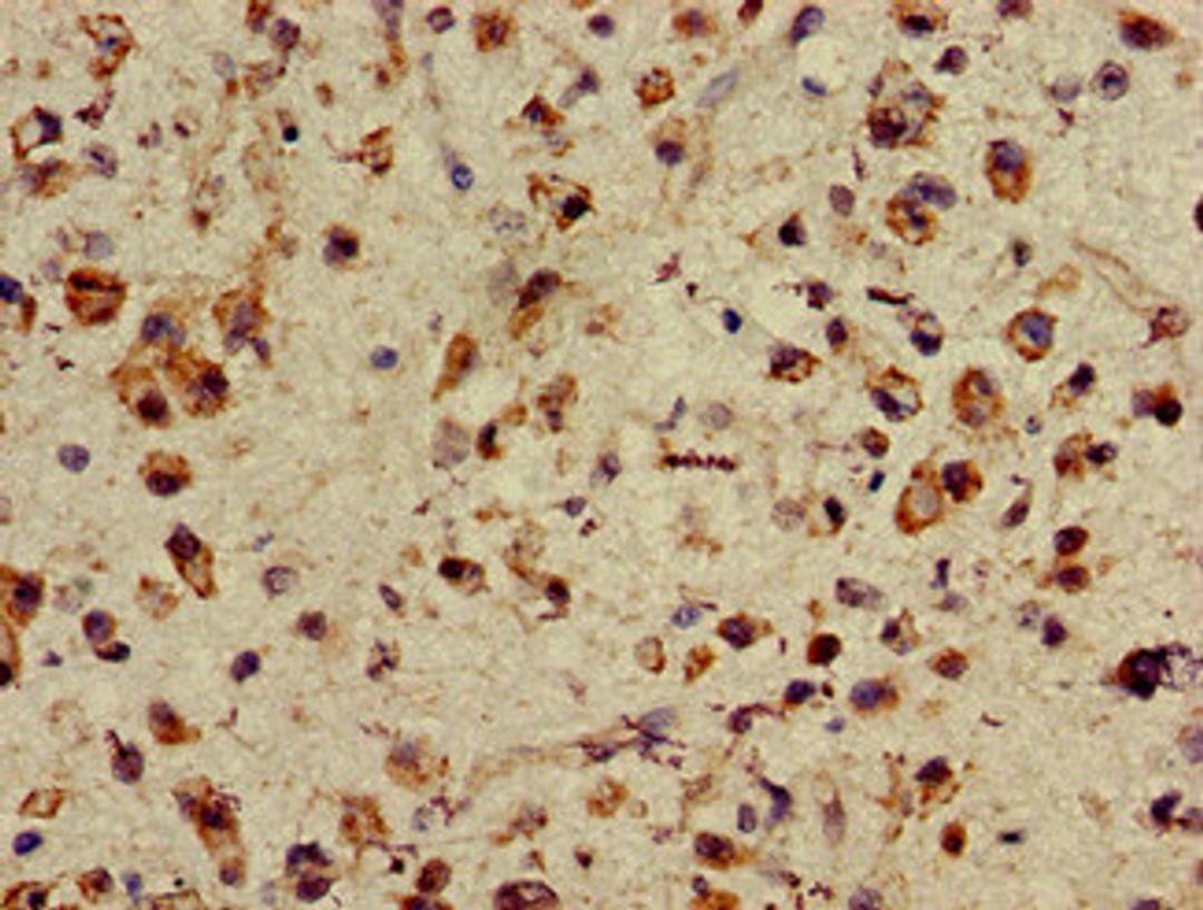 Immunohistochemistry of paraffin-embedded human glioma using CSB-PA865114LA01HU at dilution of 1:100