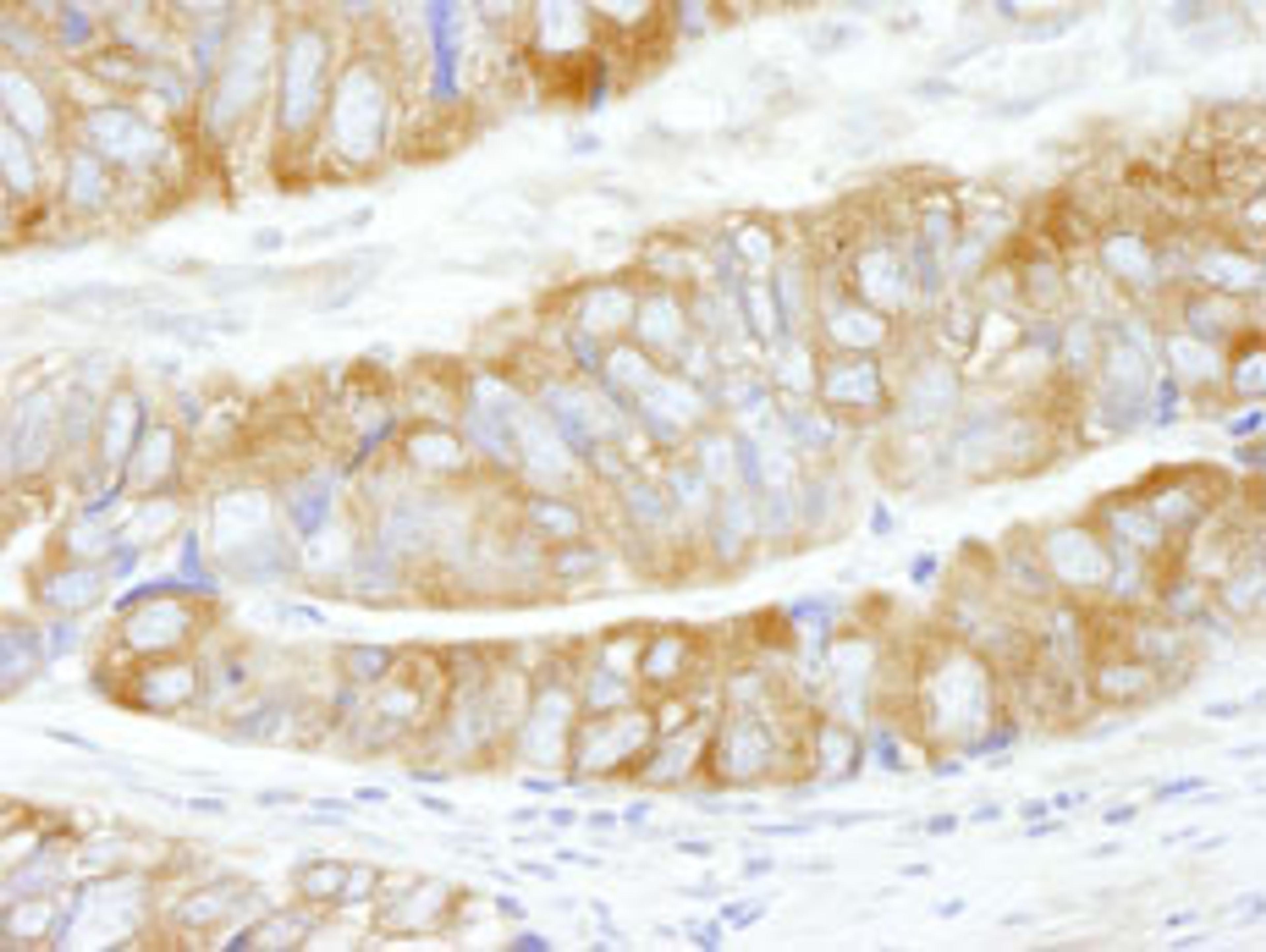 Detection of human CAD by immunohistochemistry.