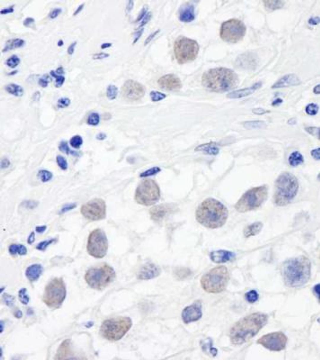 Immunohistochemistry-Paraffin: SMC3 Antibody [NB100-207] - FFPE section of human testicular seminoma.  Antibody: Affinity purified rabbit anti-SMC3  used at a dilution of 1:1,000 (1ug/ml). Detection: DAB