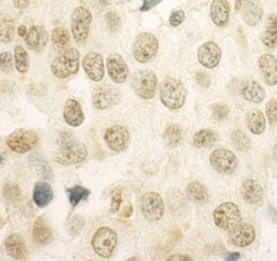 Detection of human PRCC by immunohistochemistry.