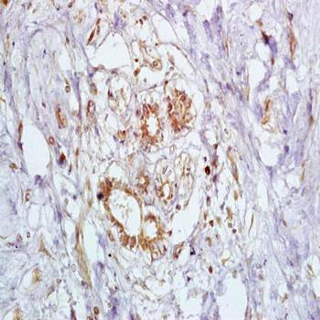 Immunohistochemical analysis of formalin-fixed and paraffin embedded human breast carcinoma tissue (dilution at:1:200) using BRCA2 antibody