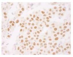 Immunohistochemistry-Paraffin: Ki67 Antibody [NB110-89719] - FFPE section of human breast carcinoma. Antibody: Affinity purified rabbit anti-Ki-67 (NB110-89719) used at a dilution of 1:250.