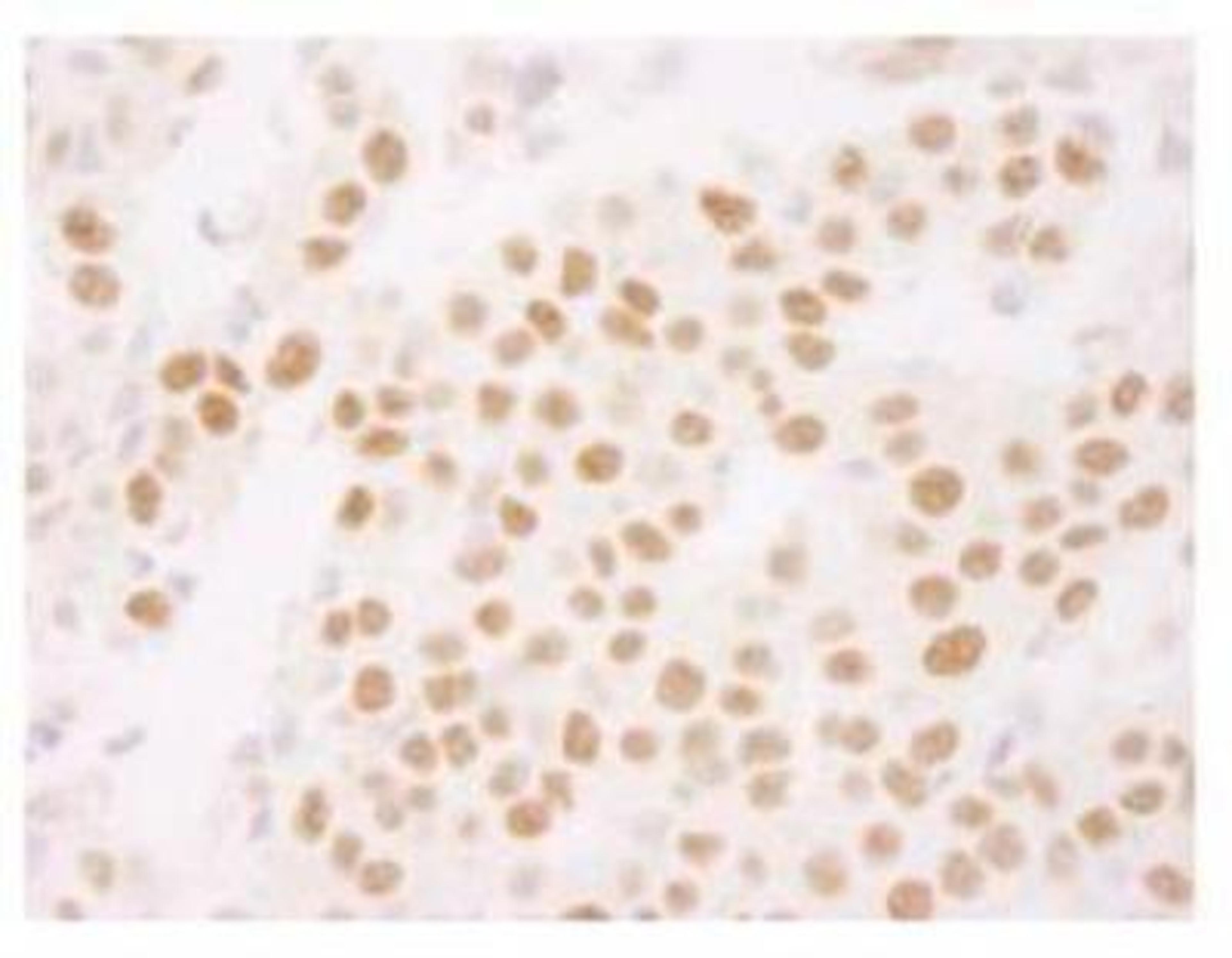 Immunohistochemistry-Paraffin: Ki67 Antibody [NB110-89719] - FFPE section of human breast carcinoma. Antibody: Affinity purified rabbit anti-Ki-67 (NB110-89719) used at a dilution of 1:250.