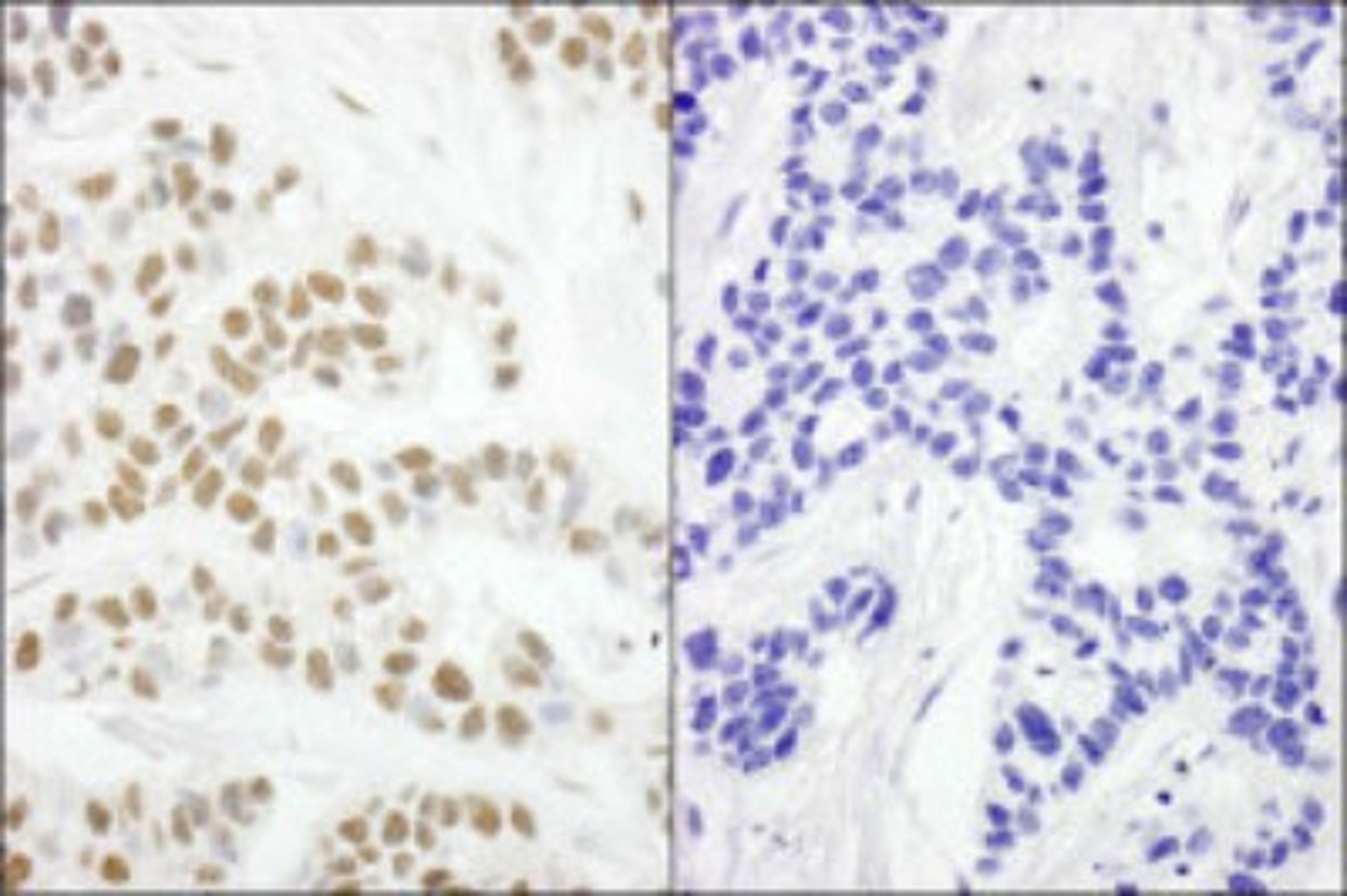 Immunohistochemistry: RPA2 [p Ser4, p Ser8] Antibody [NBP1-23017] - Human breast carcinoma. Mock phosphatase treated section (left) or calf intestinal phosphatase-treated section (right) used at a dilution of 1:250