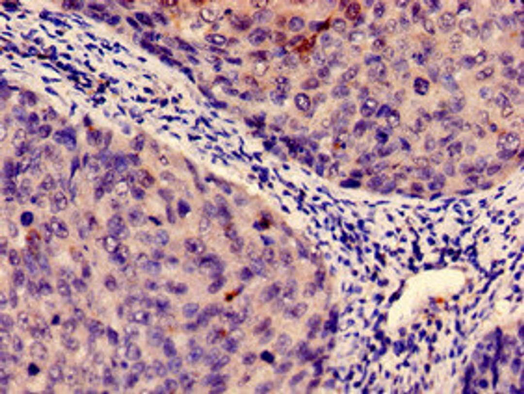 Immunohistochemistry analysis of human cervical cancer using CSB-PA010996HA01HU at dilution of 1:100
