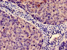 Immunohistochemistry analysis of human cervical cancer using CSB-PA010996HA01HU at dilution of 1:100