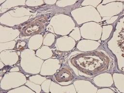 Immunohistochemical staining of human stomach cancer tissue using SOX2 antibody (2.5 ug/ml)