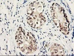 Immunohistochemistry-Paraffin: Proteasome subunit beta type 4 Antibody (2C9) [NBP2-01225] - Staining of paraffin-embedded Adenocarcinoma of Human breast tissue using anti-Proteasome subunit beta type 4 mouse monoclonal antibody.