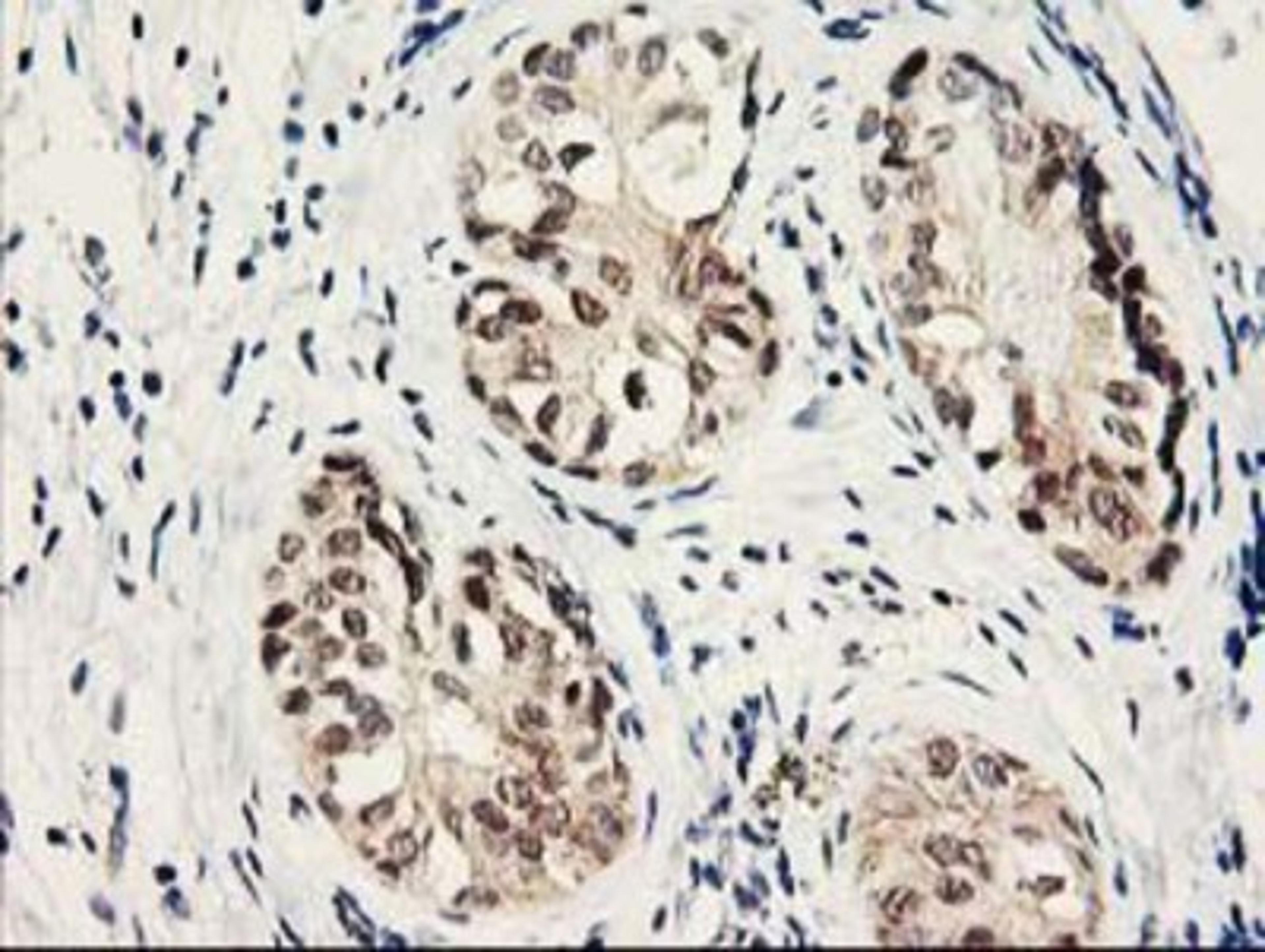 Immunohistochemistry-Paraffin: Proteasome subunit beta type 4 Antibody (2C9) [NBP2-01225] - Staining of paraffin-embedded Adenocarcinoma of Human breast tissue using anti-Proteasome subunit beta type 4 mouse monoclonal antibody.