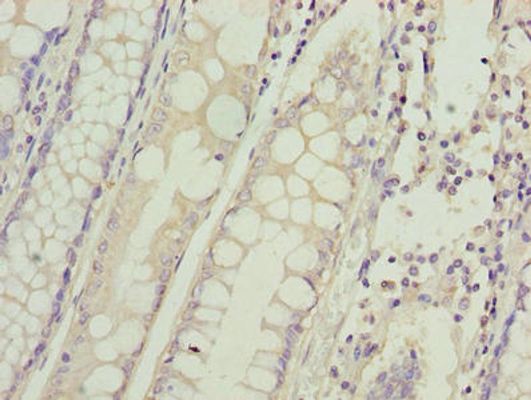 Immunohistochemistry of paraffin-embedded human colon cancer using CSB-PA889181LA01HU at dilution of 1:100