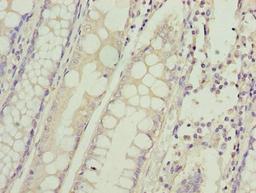 Immunohistochemistry of paraffin-embedded human colon cancer using CSB-PA889181LA01HU at dilution of 1:100