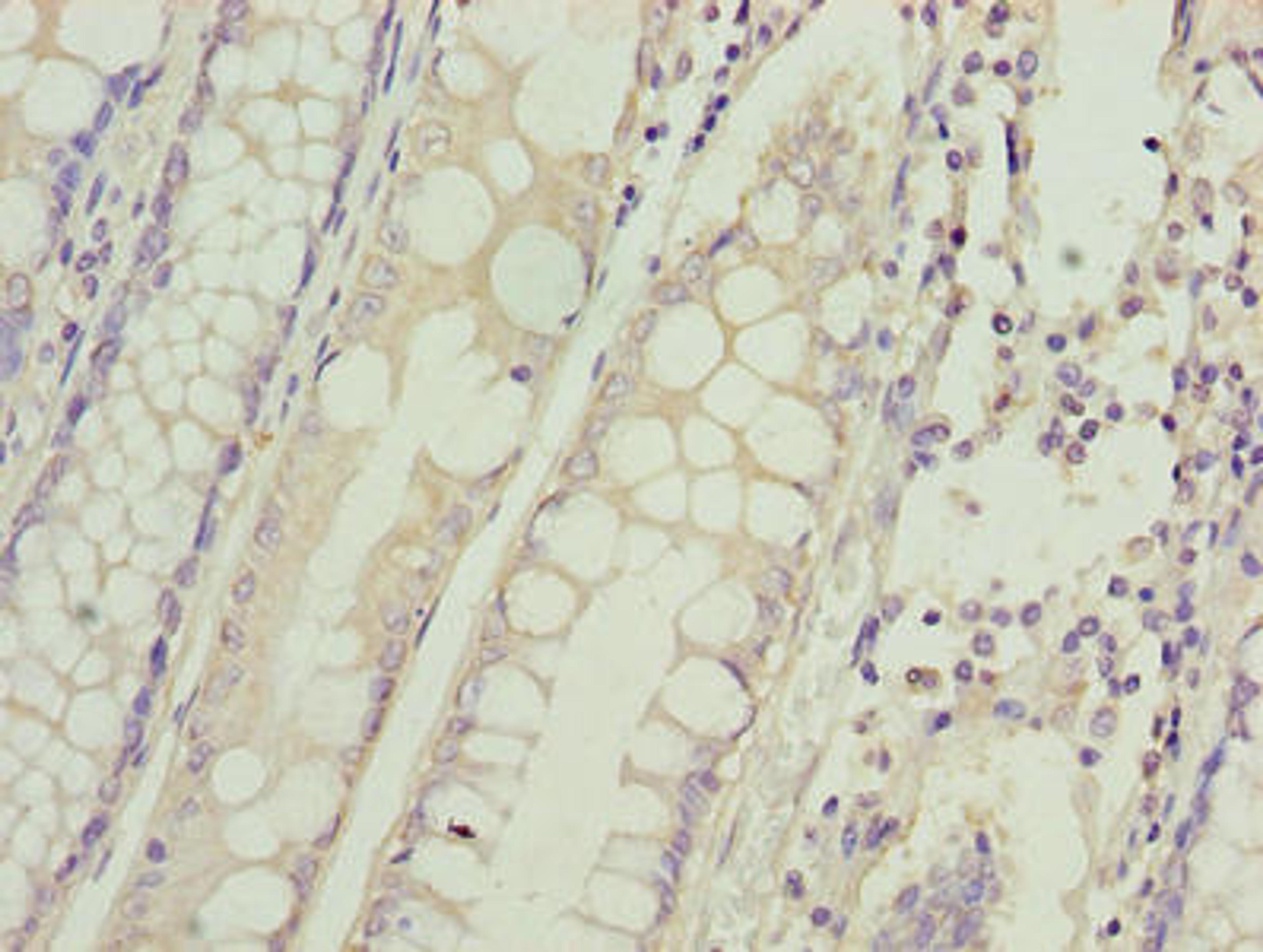 Immunohistochemistry of paraffin-embedded human colon cancer using CSB-PA889181LA01HU at dilution of 1:100