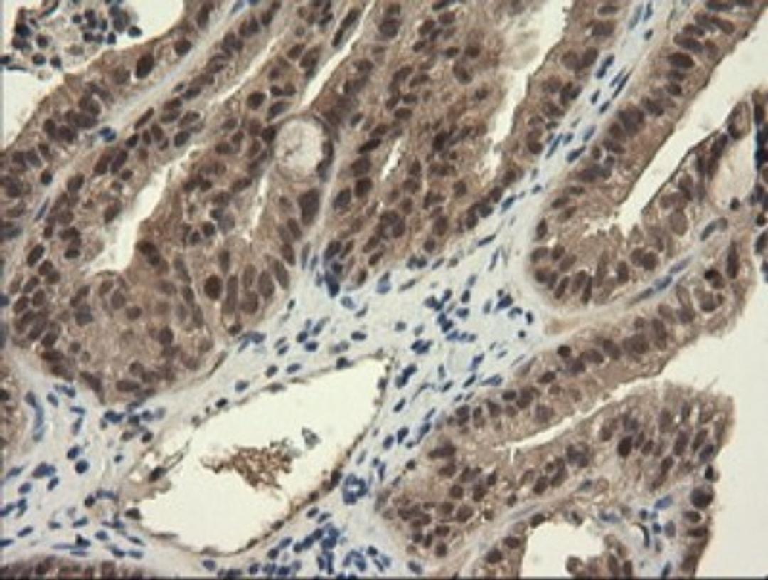 Immunohistochemistry: TRIM45 Antibody (3G3) [NBP2-46223] - Analysis of Adenocarcinoma of Human ovary tissue. (Heat-induced epitope retrieval by 10mM citric buffer, pH6.0, 120C for 3min)