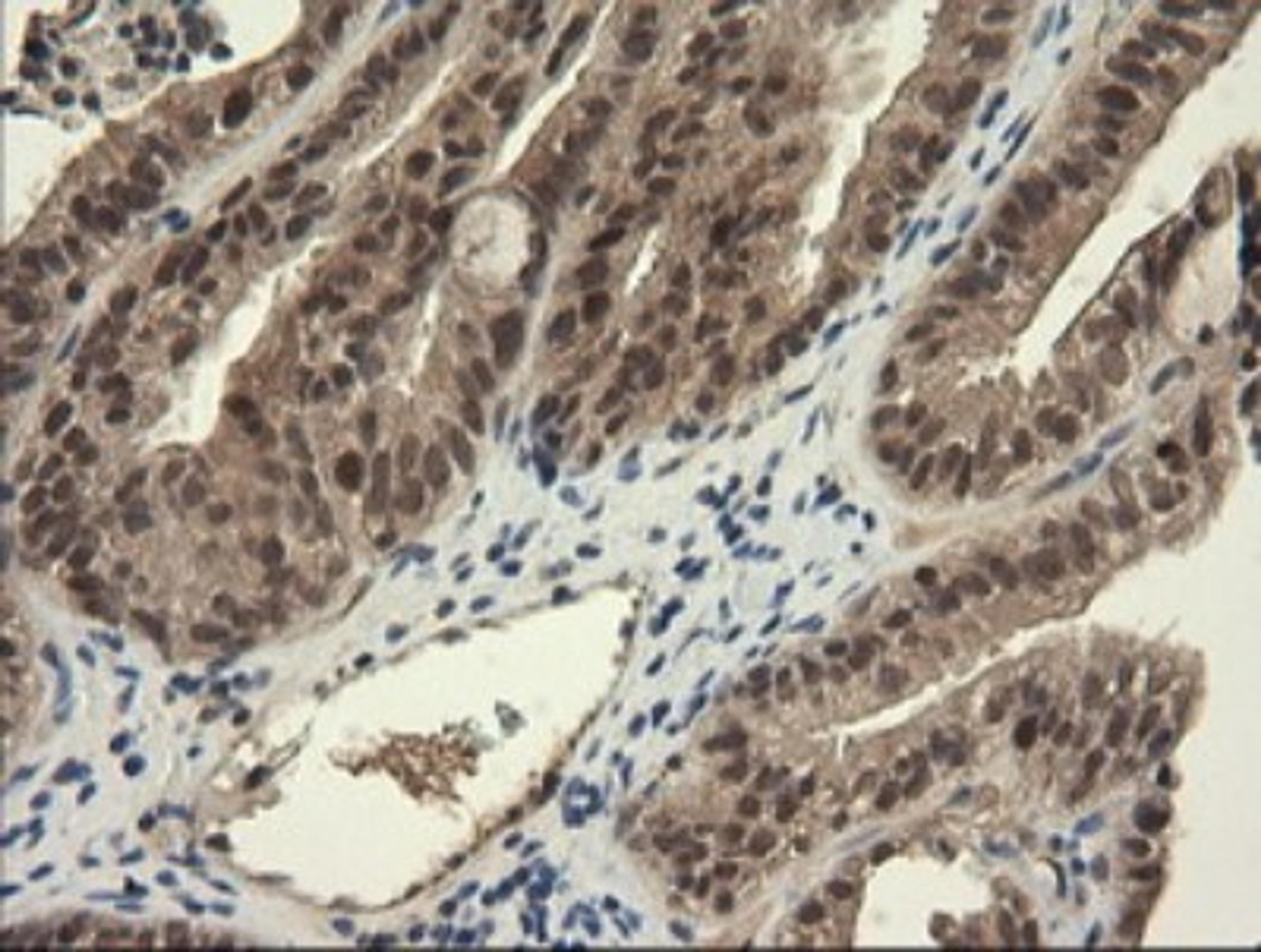 Immunohistochemistry: TRIM45 Antibody (3G3) [NBP2-46223] - Analysis of Adenocarcinoma of Human ovary tissue. (Heat-induced epitope retrieval by 10mM citric buffer, pH6.0, 120C for 3min)