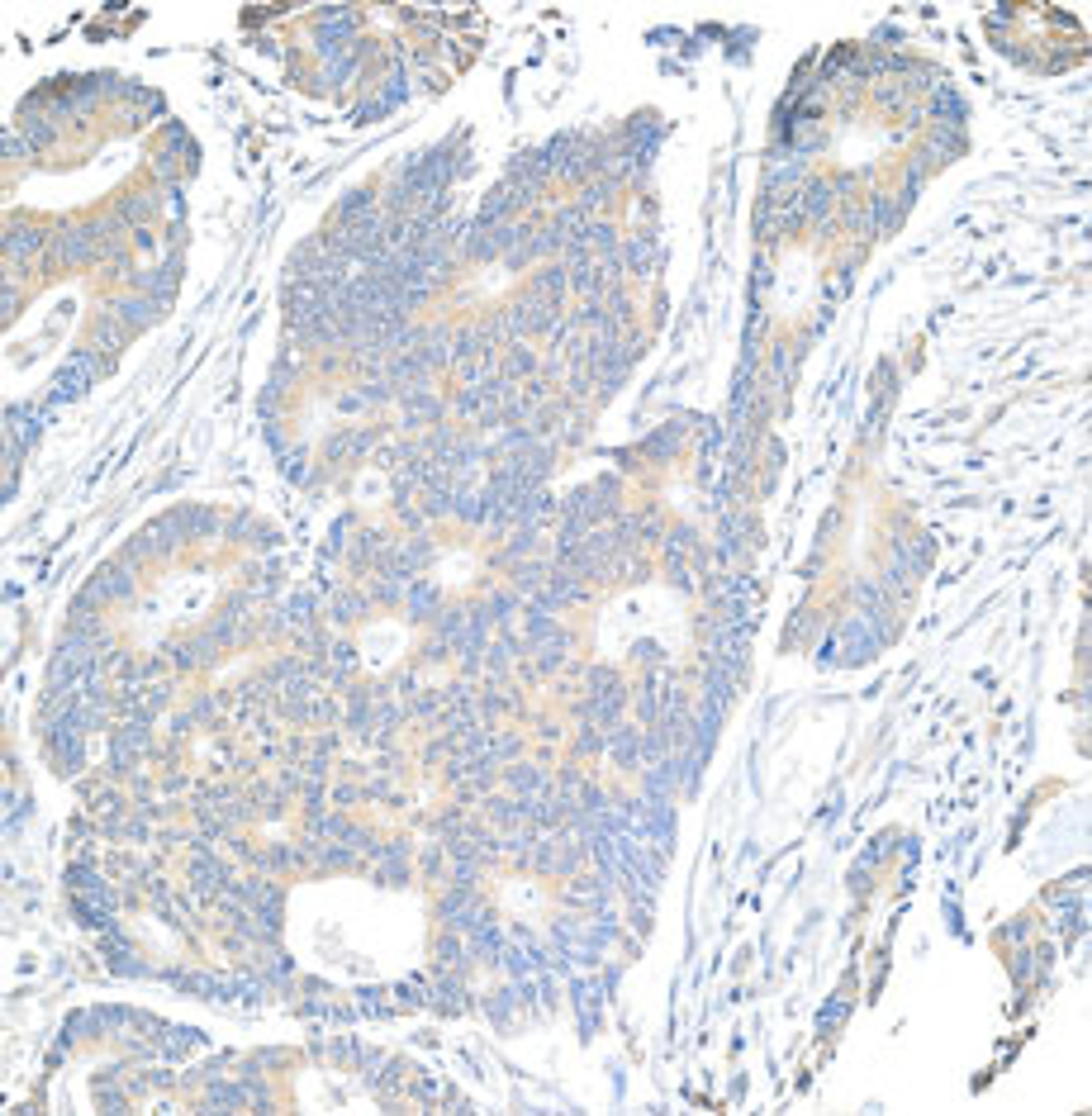 Detection of human Notch1 by immunohistochemistry.