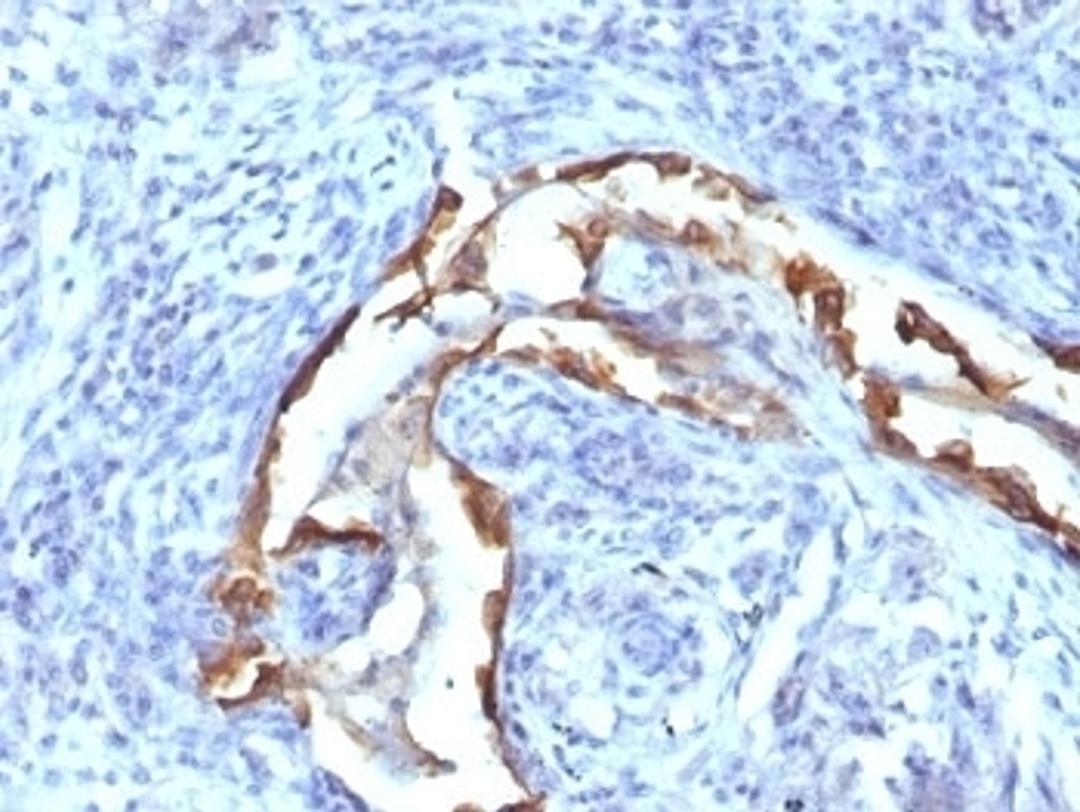 Formalin-fixed, paraffin-embedded human lung carcinoma stained with Cytokeratin 8 antibody (SPM538).