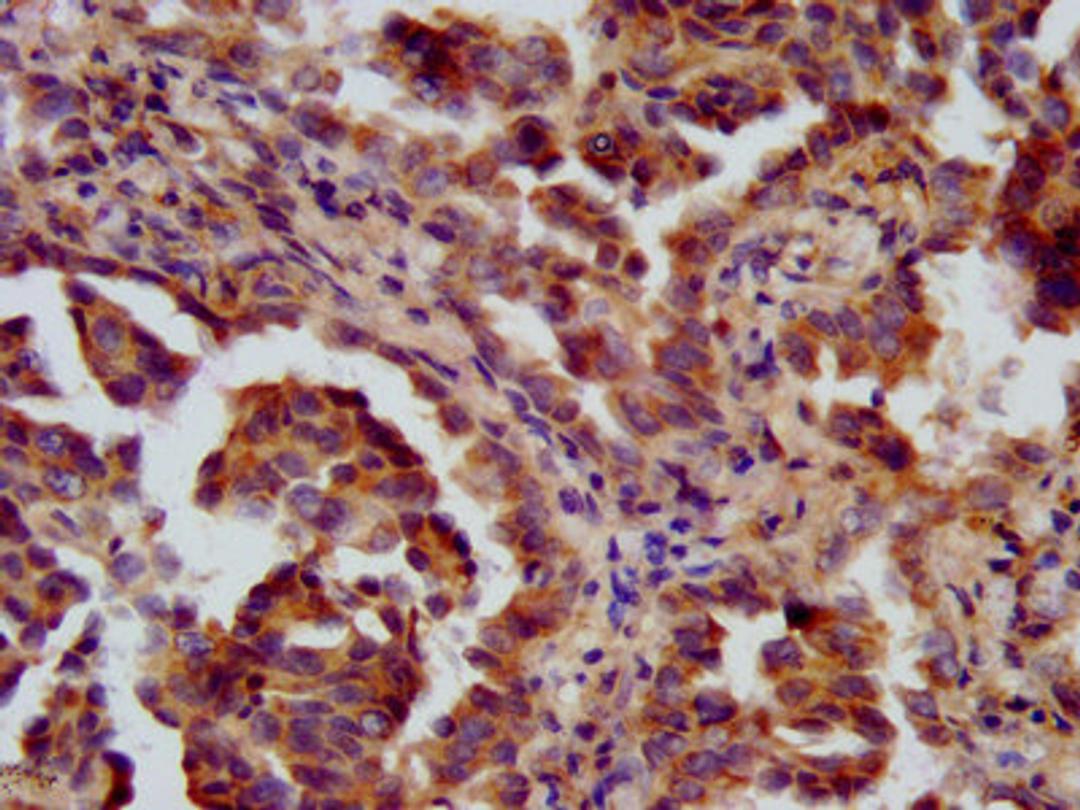IHC image of CSB-PA882120LA01HU diluted at 1:600 and staining in paraffin-embedded human lung cancer performed on a Leica BondTM system. After dewaxing and hydration, antigen retrieval was mediated by high pressure in a citrate buffer (pH 6.0). Section was blocked with 10% normal goat serum 30min at RT. Then primary antibody (1% BSA) was incubated at 4°C overnight. The primary is detected by a biotinylated secondary antibody and visualized using an HRP conjugated SP system.