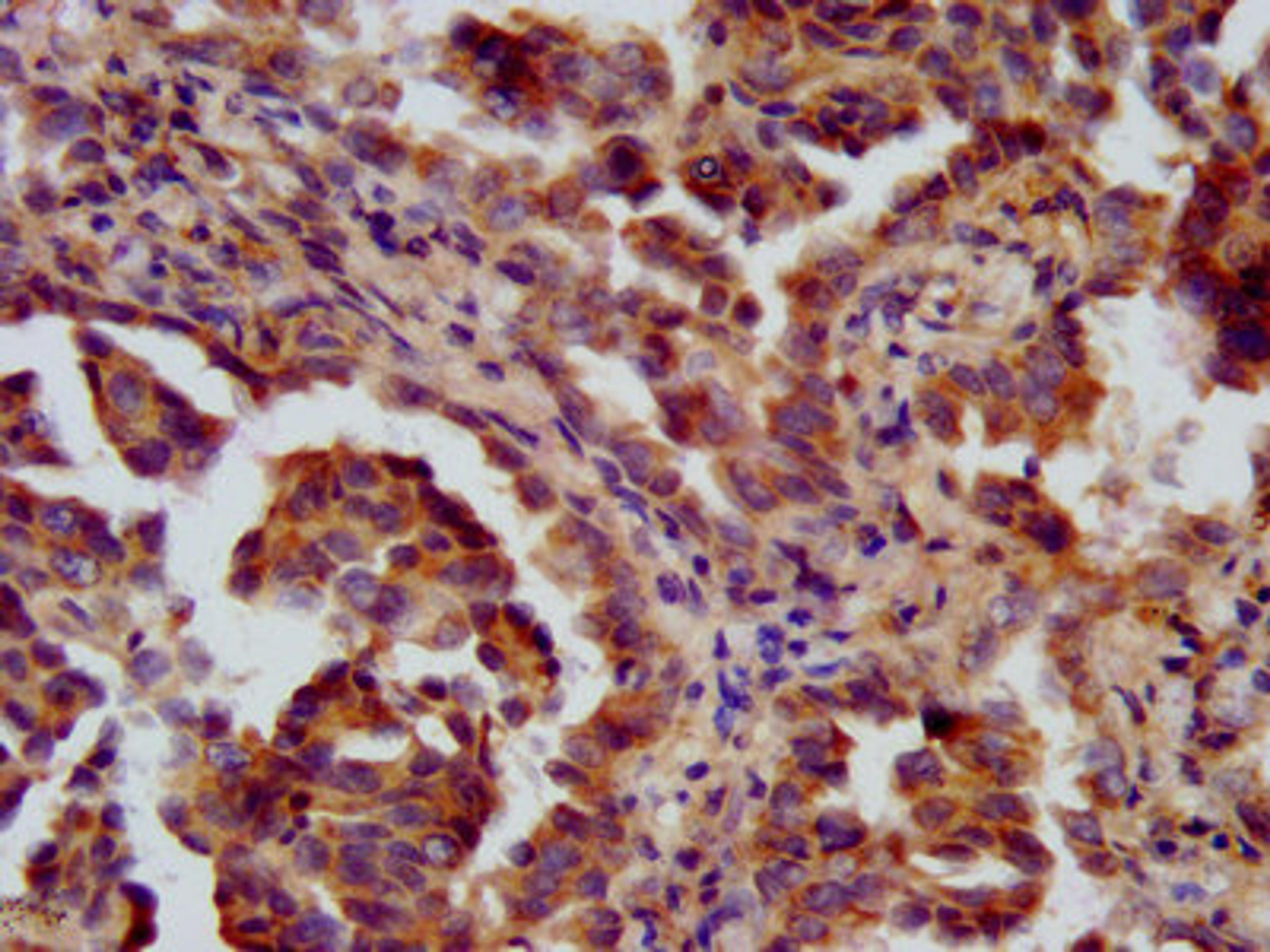 IHC image of CSB-PA882120LA01HU diluted at 1:600 and staining in paraffin-embedded human lung cancer performed on a Leica BondTM system. After dewaxing and hydration, antigen retrieval was mediated by high pressure in a citrate buffer (pH 6.0). Section was blocked with 10% normal goat serum 30min at RT. Then primary antibody (1% BSA) was incubated at 4°C overnight. The primary is detected by a biotinylated secondary antibody and visualized using an HRP conjugated SP system.