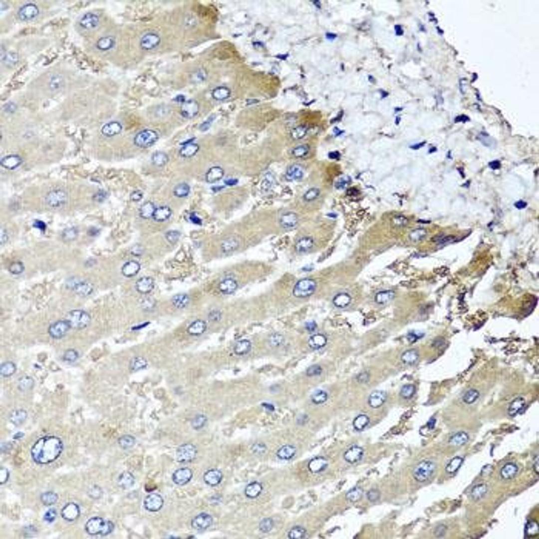 Immunohistochemical staining of human liver injury tissue using MGAT1 antibody (dilution of 1:100)