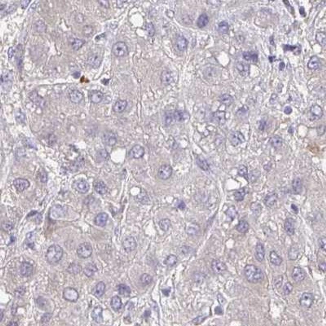 Immunohistochemistry: FAM5C Antibody [NBP2-31581] - liver cancer