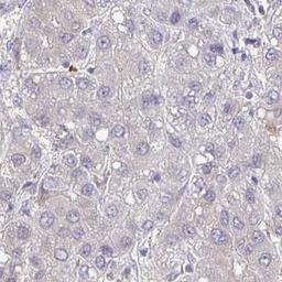 Immunohistochemistry: FAM5C Antibody [NBP2-31581] - liver cancer