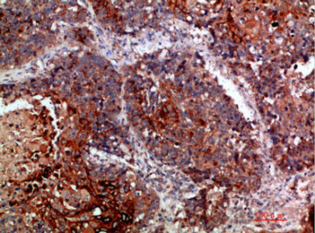 Immunohistochemical analysis of paraffin-embedded human-lung-cancer, antibody was diluted at 1:200