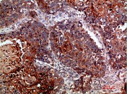 Immunohistochemical analysis of paraffin-embedded human-lung-cancer, antibody was diluted at 1:200