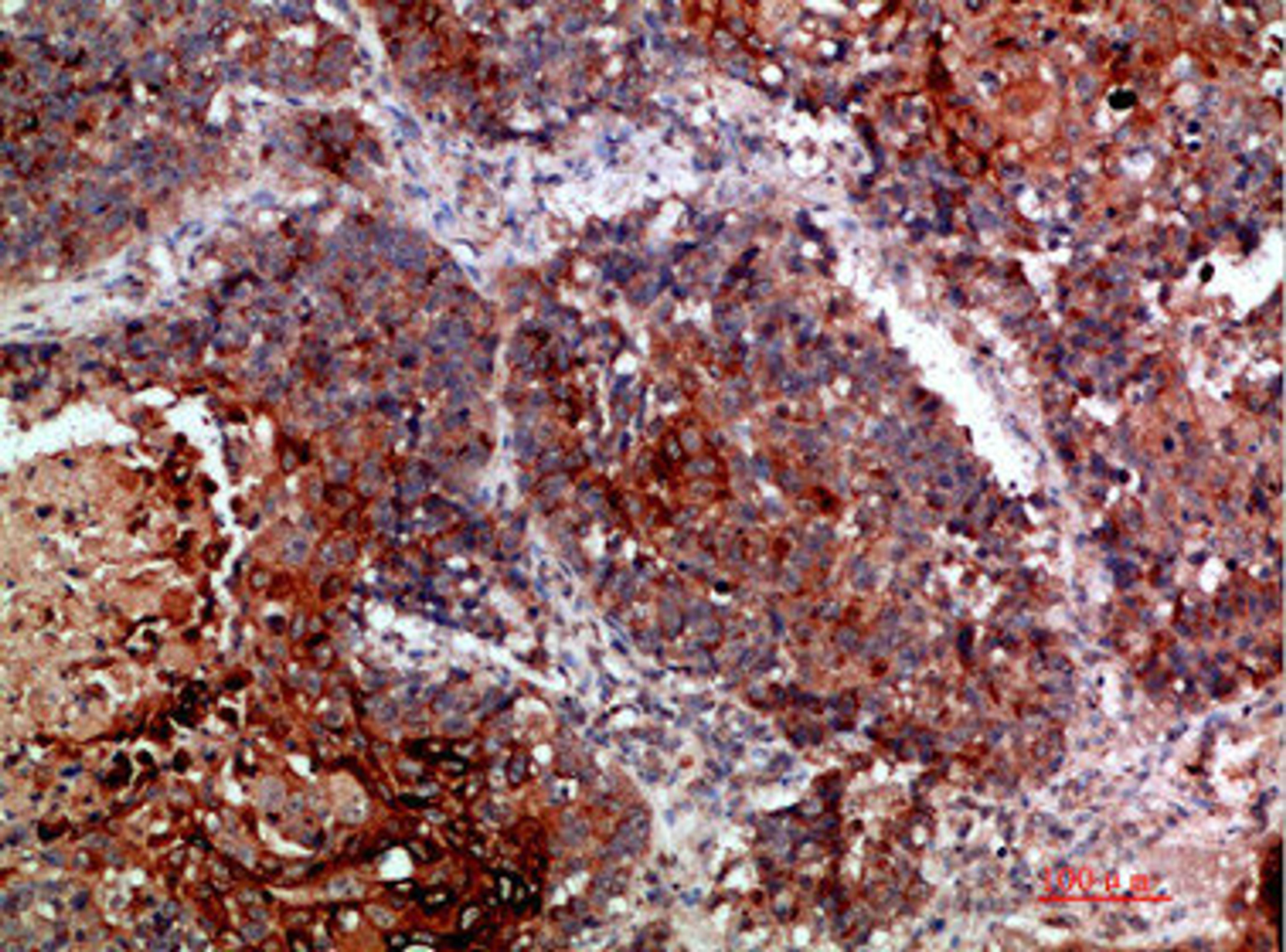 Immunohistochemical analysis of paraffin-embedded human-lung-cancer, antibody was diluted at 1:200