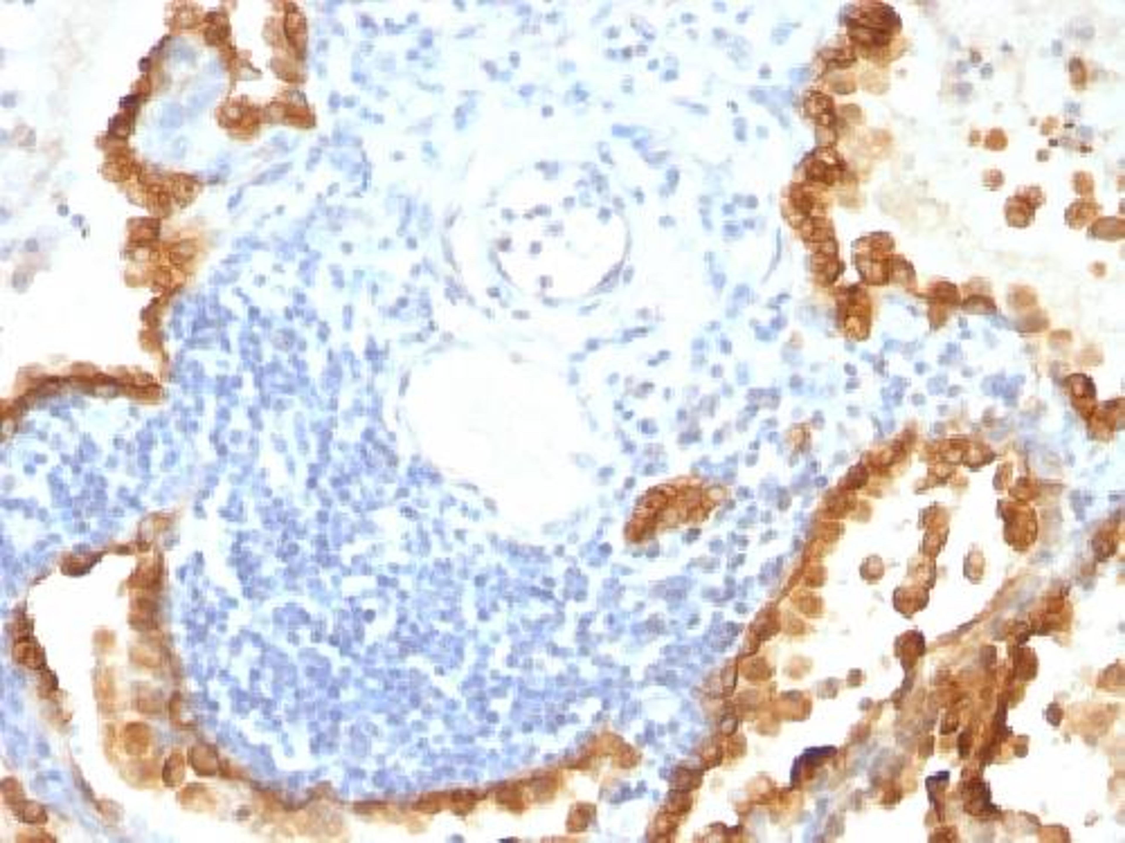 Immunohistochemical staining of human Lung Carcinoma tissue using Cytokeratin 8/18 antibody