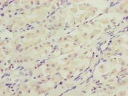 Immunohistochemistry of paraffin-embedded human gastric cancer using CSB-PA006589LA01HU at dilution of 1:100
