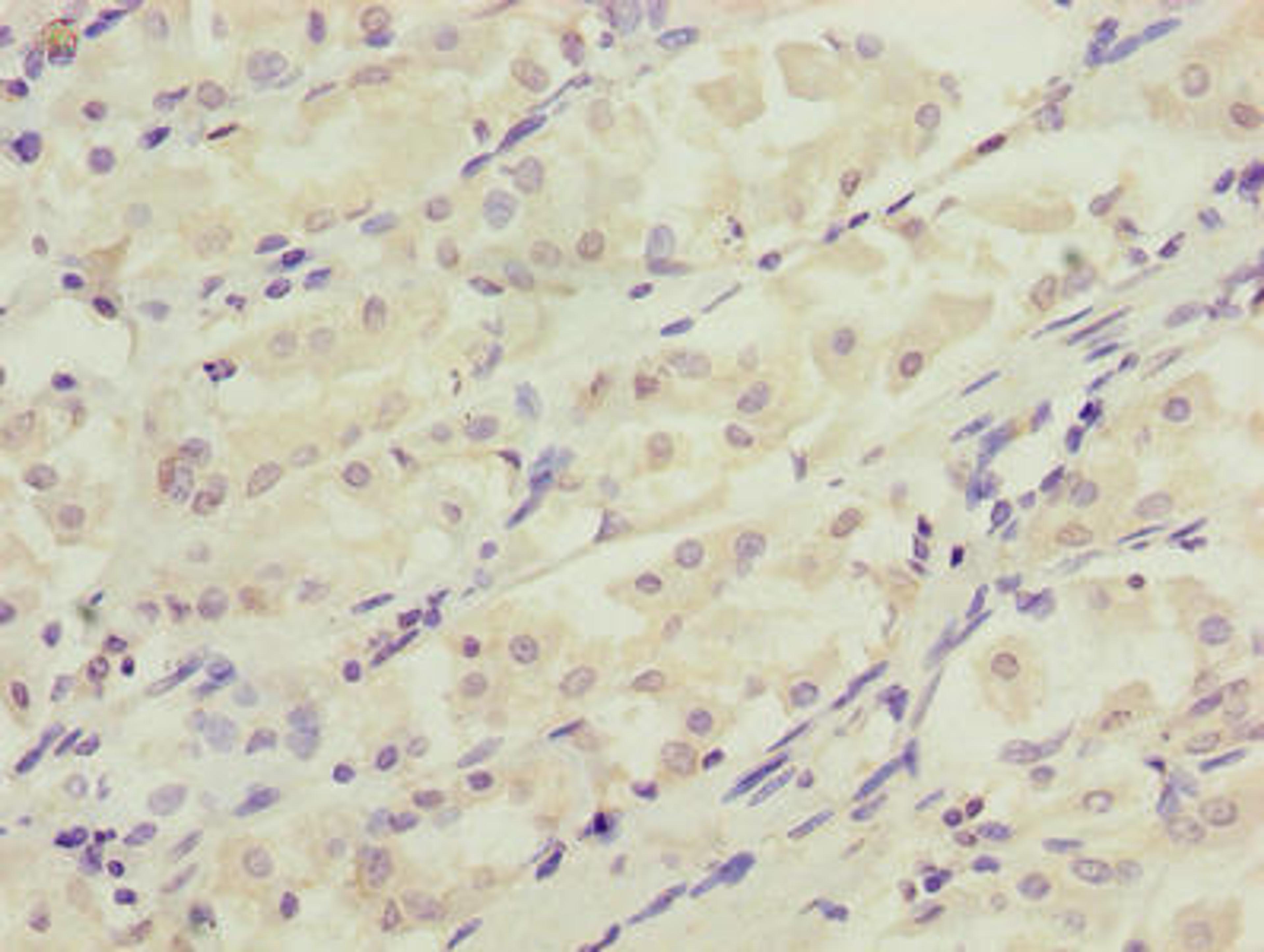 Immunohistochemistry of paraffin-embedded human gastric cancer using CSB-PA006589LA01HU at dilution of 1:100