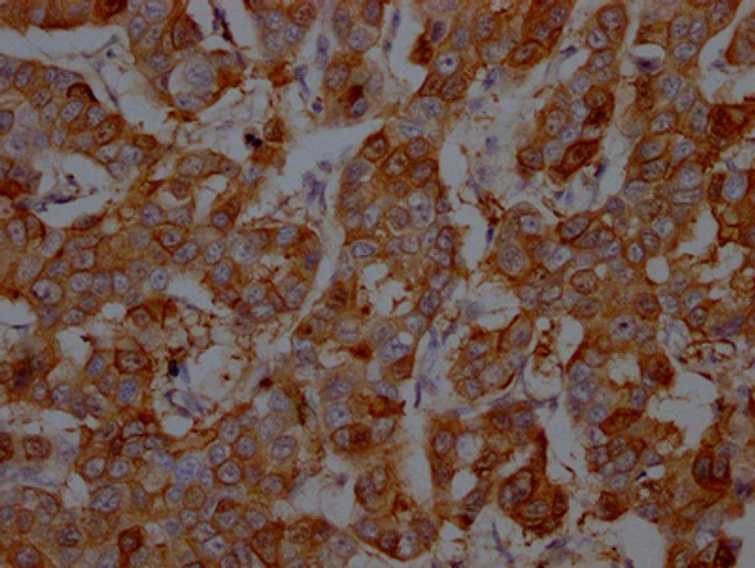 IHC image of CSB-RA958800A0HU diluted at 1:100 and staining in paraffin-embedded human breast cancer performed on a Leica BondTM system. After dewaxing and hydration, antigen retrieval was mediated by high pressure in a citrate buffer (pH 6.0). Section was blocked with 10% normal goat serum 30min at RT. Then primary antibody (1% BSA) was incubated at 4℃ overnight. The primary is detected by a Goat anti-rabbit IgG polymer labeled by HRP and visualized using 0.05% DAB.