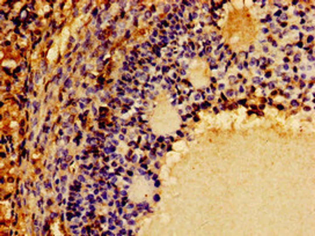 Immunohistochemistry of paraffin-embedded human ovarian cancer using CSB-PA006047LA01HU at dilution of 1:100