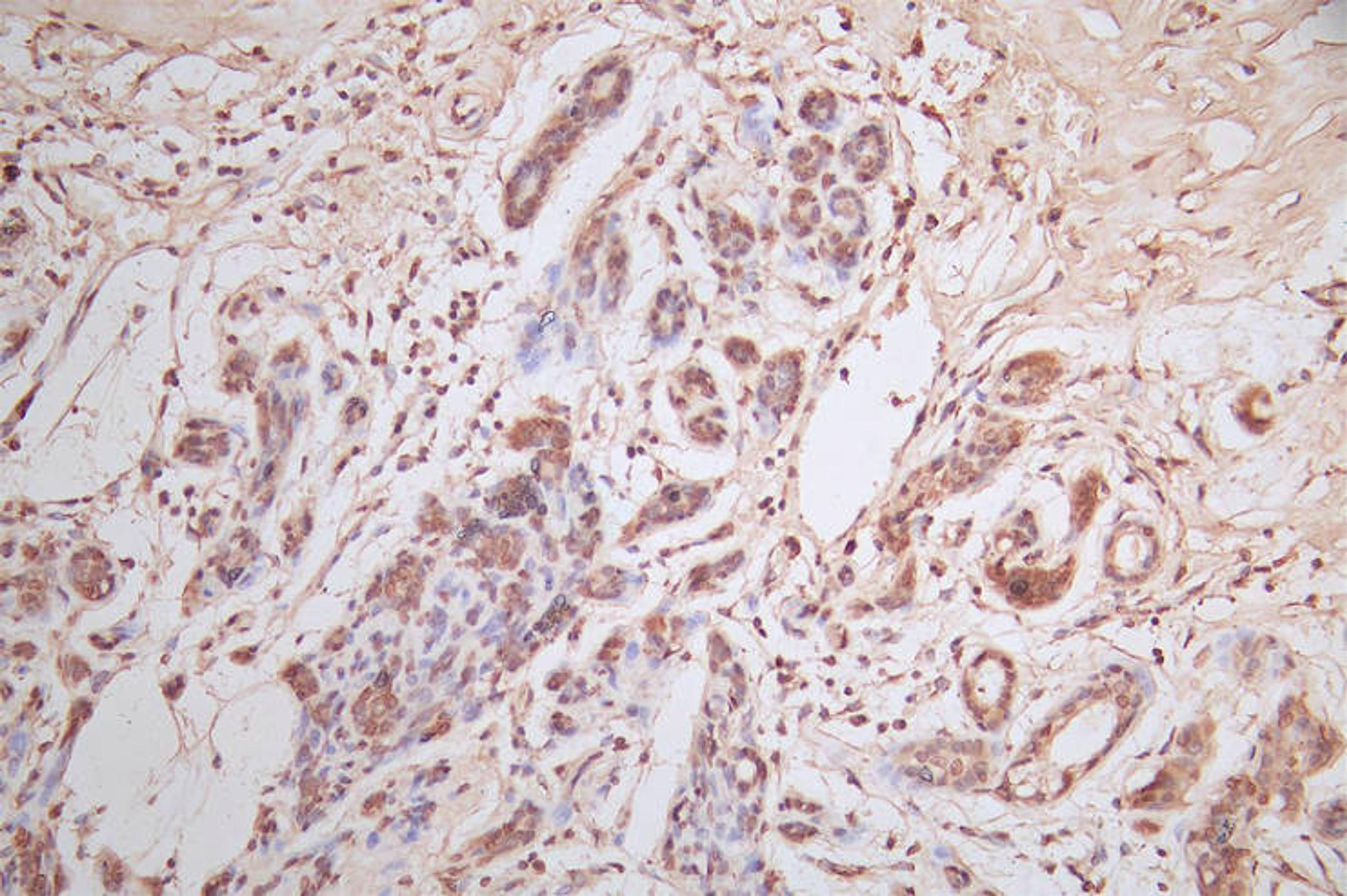 IHC image of CSB-RA007763MA2HU diluted at 1:600 and staining in paraffin-embedded human breast cancer performed on a Leica BondTM system. After dewaxing and hydration, antigen retrieval was mediated by high pressure in a citrate buffer (pH 6.0). Section was blocked with 10% normal goat serum 30min at RT. Then primary antibody (1% BSA) was incubated at 4°C overnight. The primary is detected by a Goat anti-Mouse IgG labeled by HRP and visualized using 0.05% DAB.