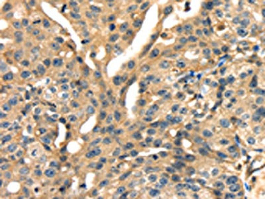 The image on the left is immunohistochemistry of paraffin-embedded Human gastic cancer tissue using CSB-PA558622(ANXA13 Antibody) at dilution 1/15, on the right is treated with fusion protein. (Original magnification: ×200)