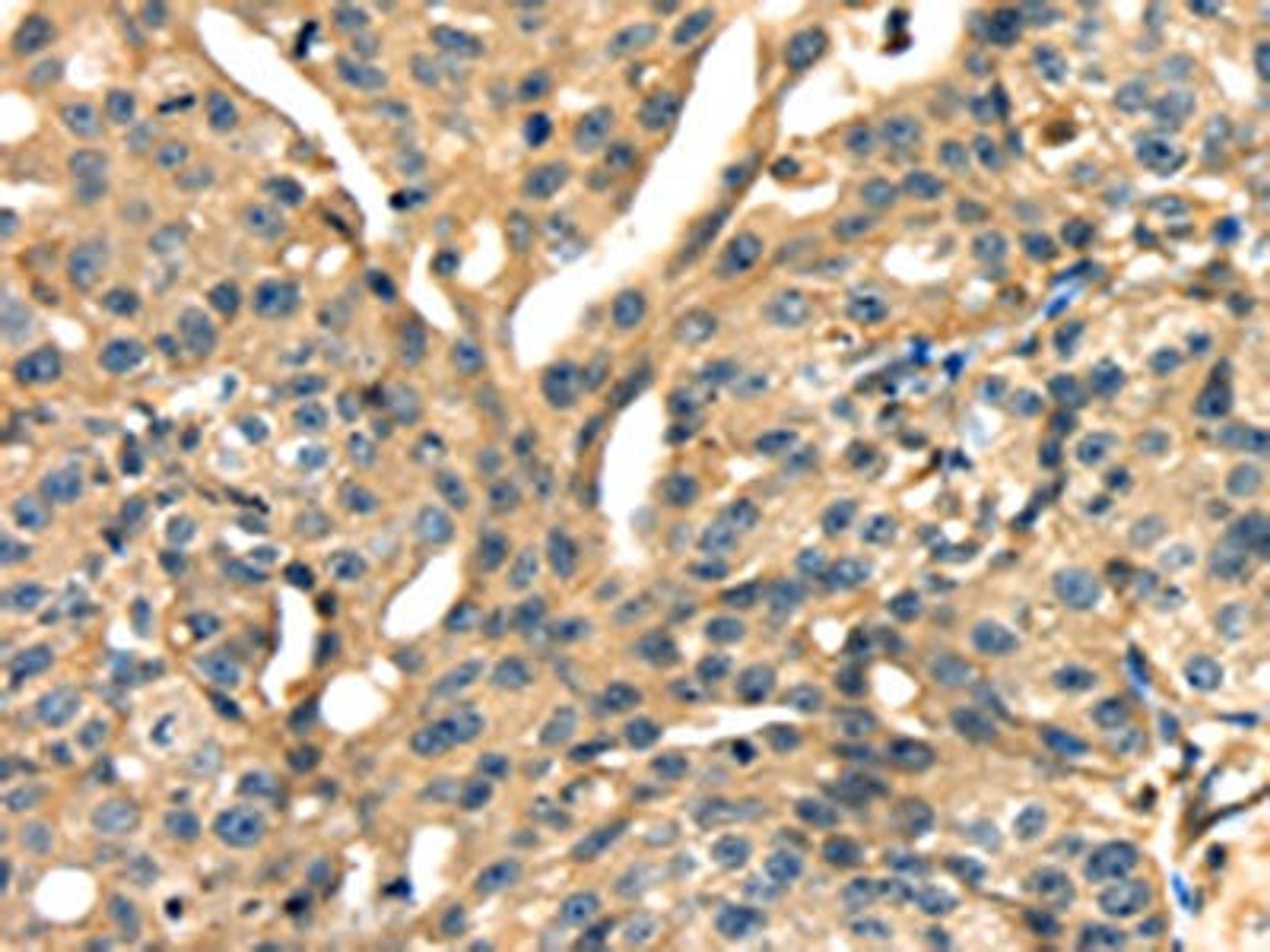 The image on the left is immunohistochemistry of paraffin-embedded Human gastic cancer tissue using CSB-PA558622(ANXA13 Antibody) at dilution 1/15, on the right is treated with fusion protein. (Original magnification: ×200)