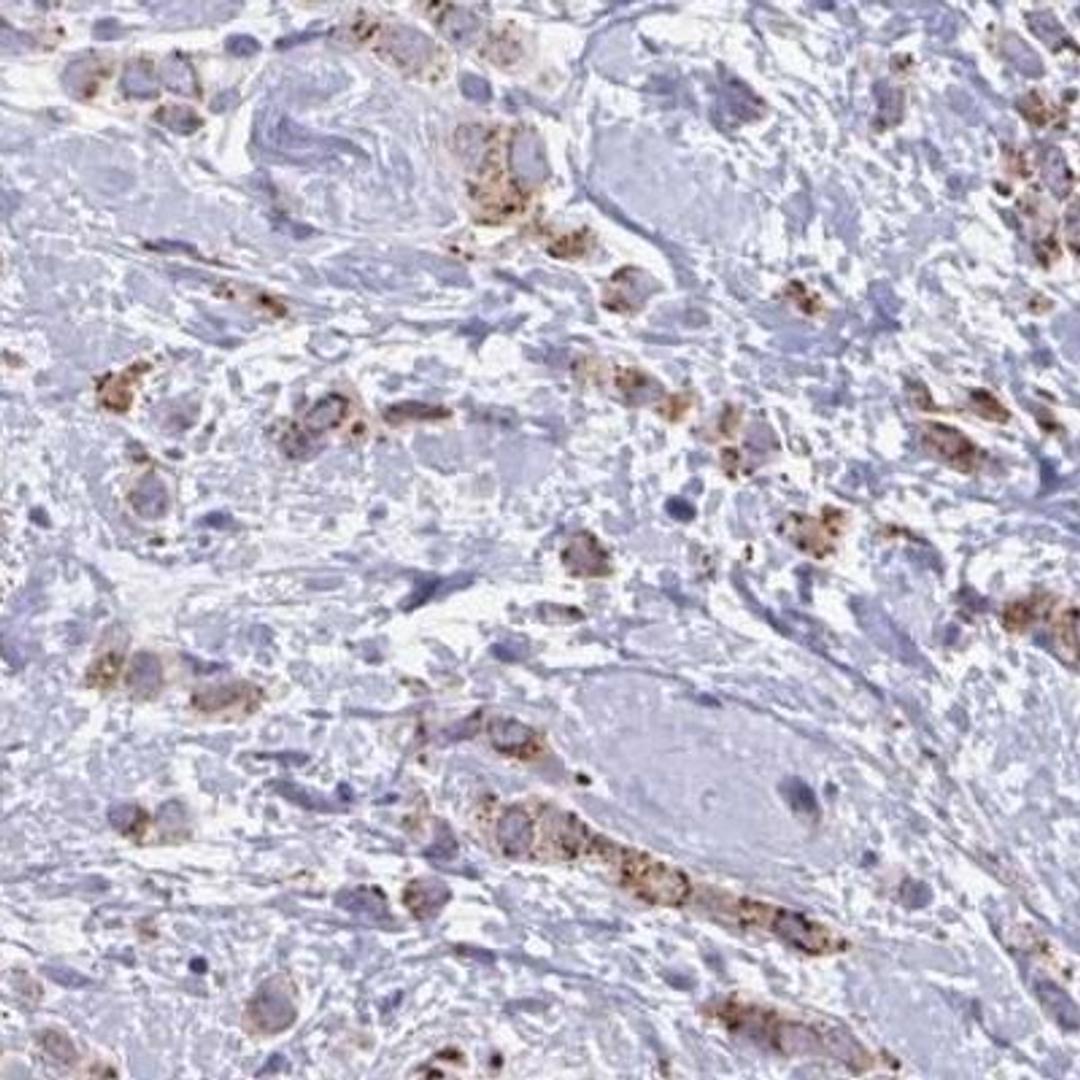 Immunohistochemistry: OLFM2 Antibody [NBP2-31692] - breast cancer