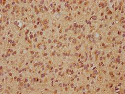 IHC image of CSB-PA007886LA01HU diluted at 1:560 and staining in paraffin-embedded human glioma cancer performed on a Leica BondTM system. After dewaxing and hydration, antigen retrieval was mediated by high pressure in a citrate buffer (pH 6.0). Section was blocked with 10% normal goat serum 30min at RT. Then primary antibody (1% BSA) was incubated at 4°C overnight. The primary is detected by a biotinylated secondary antibody and visualized using an HRP conjugated SP system.