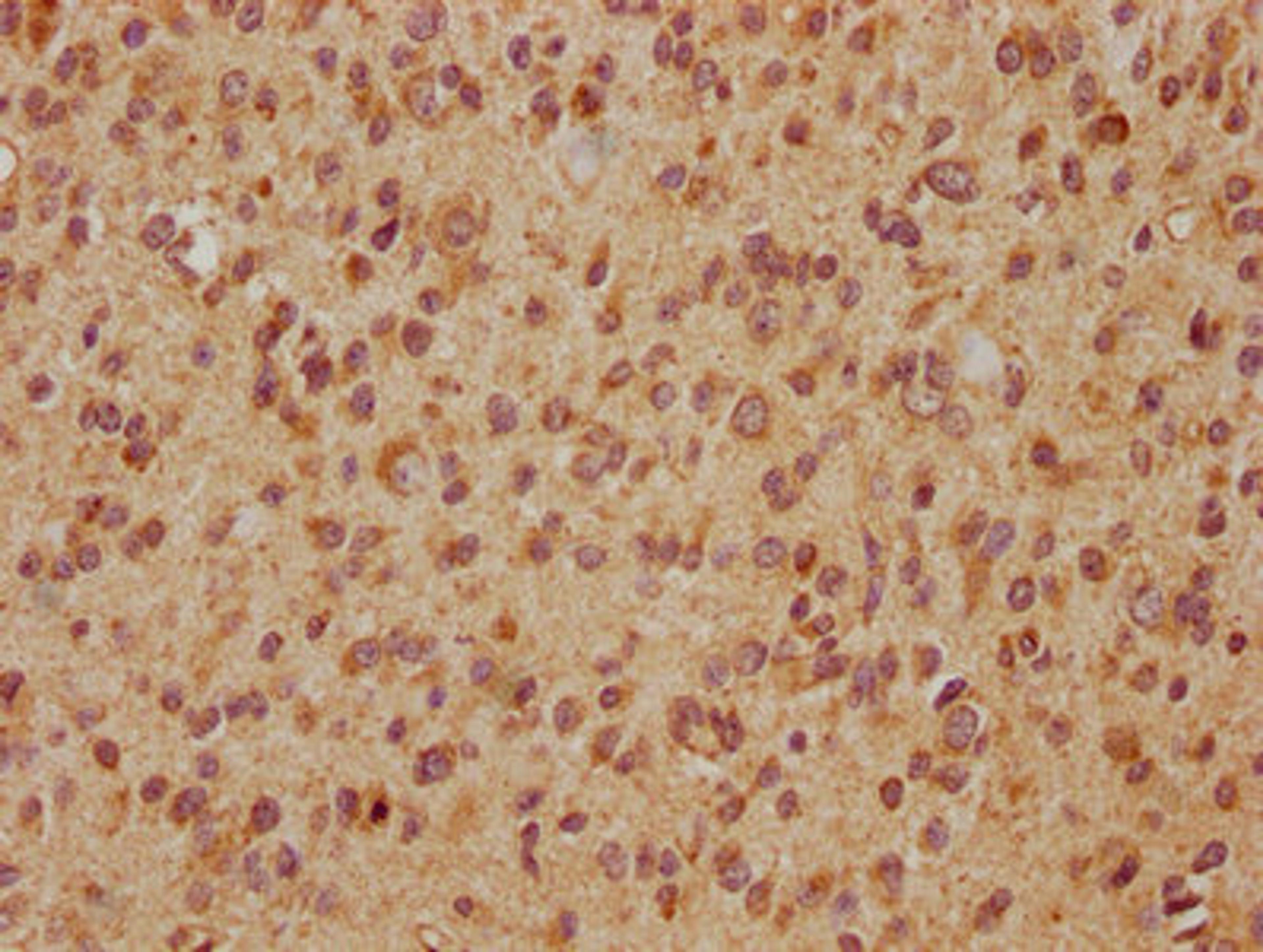IHC image of CSB-PA007886LA01HU diluted at 1:560 and staining in paraffin-embedded human glioma cancer performed on a Leica BondTM system. After dewaxing and hydration, antigen retrieval was mediated by high pressure in a citrate buffer (pH 6.0). Section was blocked with 10% normal goat serum 30min at RT. Then primary antibody (1% BSA) was incubated at 4°C overnight. The primary is detected by a biotinylated secondary antibody and visualized using an HRP conjugated SP system.
